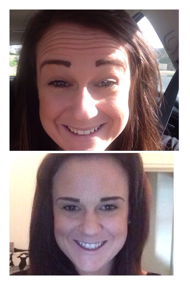 Before and After Botulinum Toxin treatment